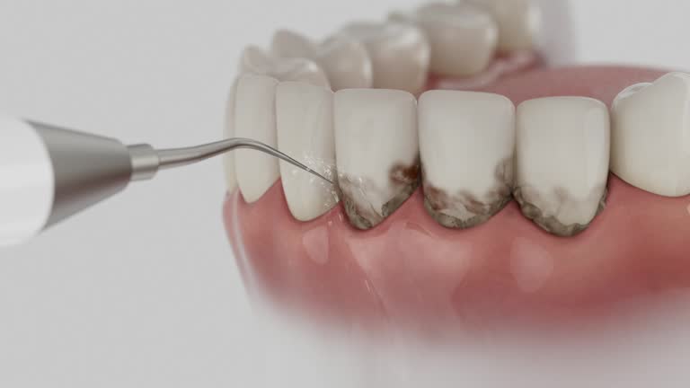 Trusted Wisdom Tooth Removal service in Baudette, MN - Dentist Open Now